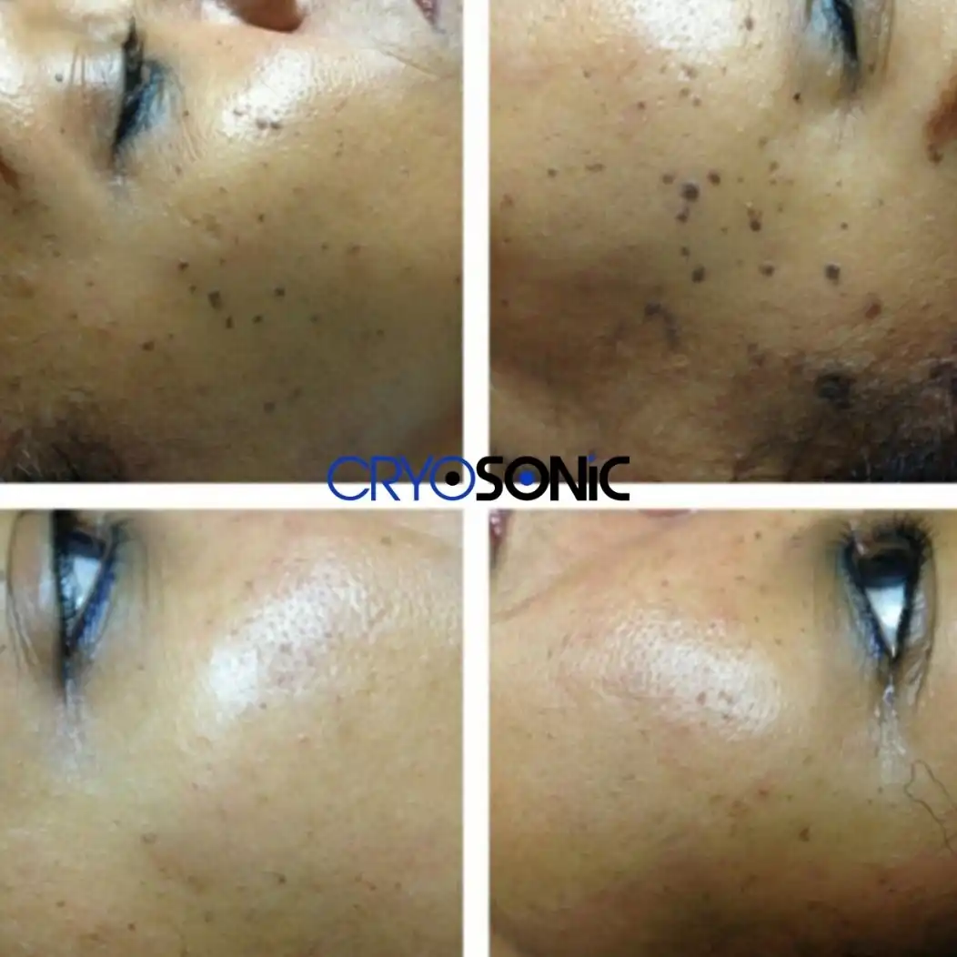 Why Skin Shows Pigmentation After Treatment Southall