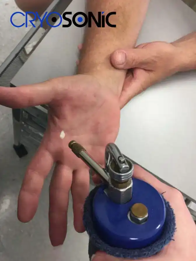 Temperature Differences: OTC vs Medical-Grade Cryotherapy Southall